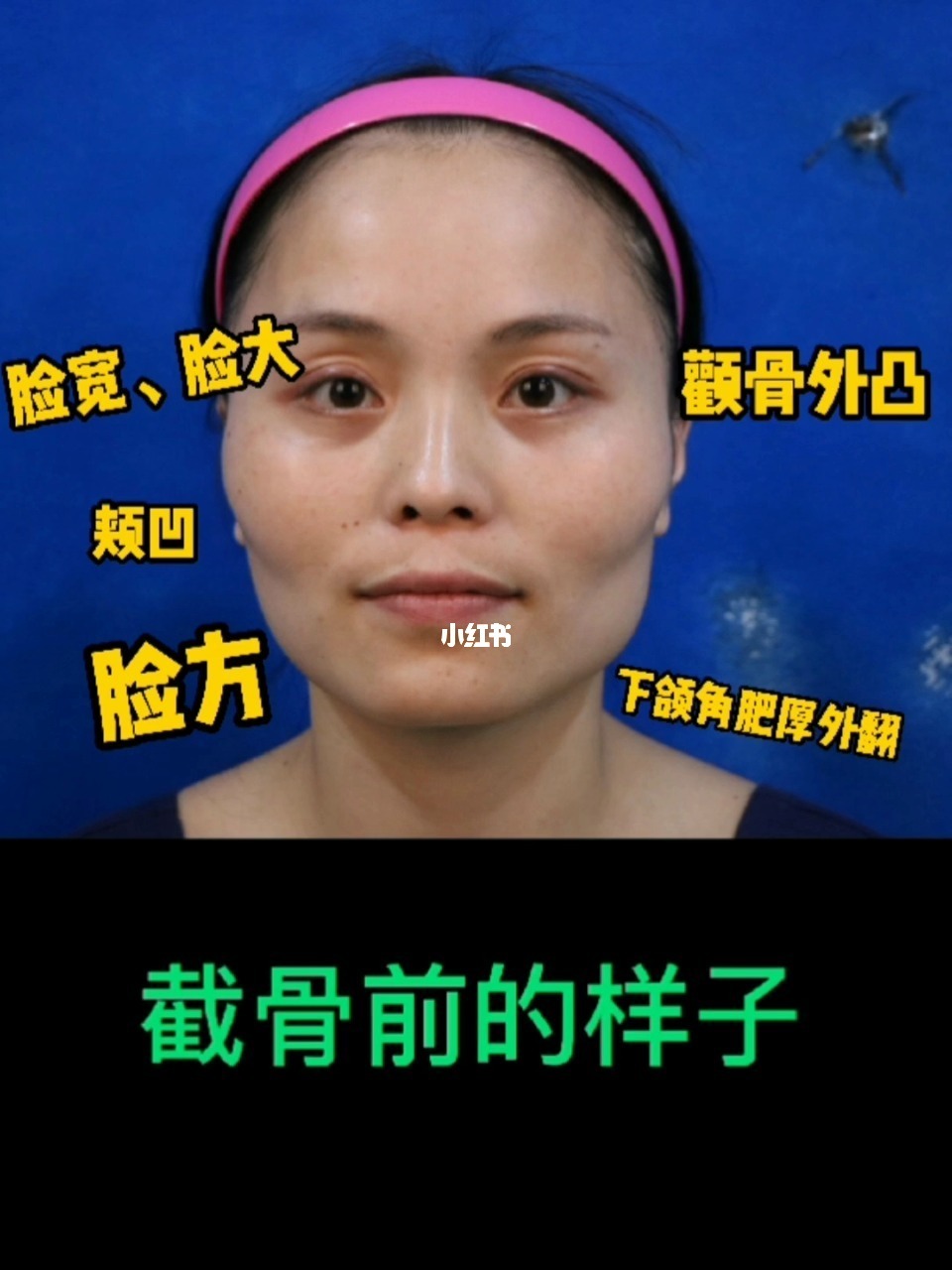 男人眼睛凹陷面相图解_眉头上方凹陷面相图解_中正凹陷女人面相图解